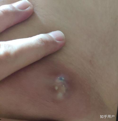 火疖子视频